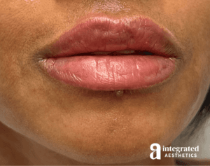 Dermal Fillers