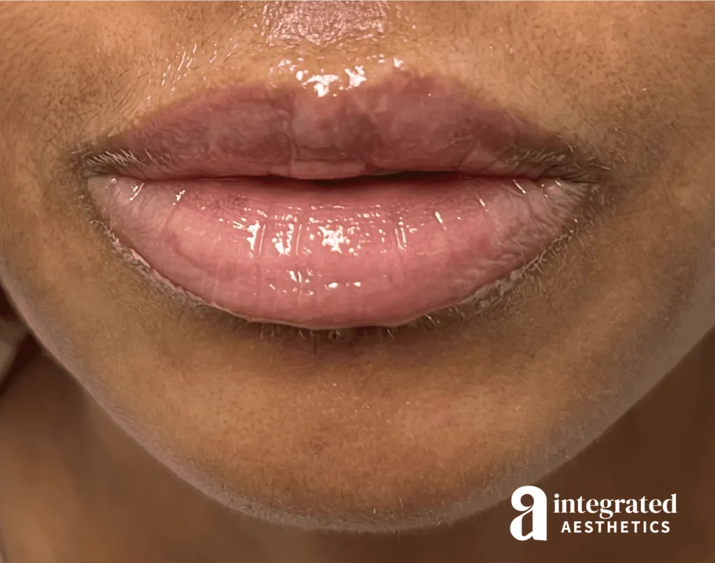 Dermal Fillers