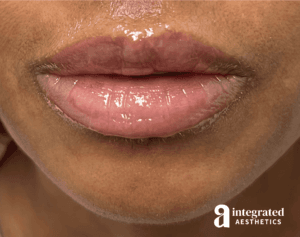 Dermal Fillers