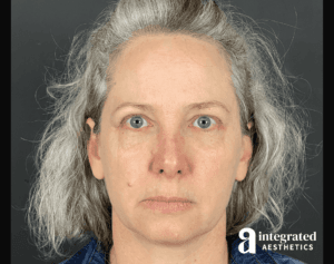 Wrinkle Relaxers