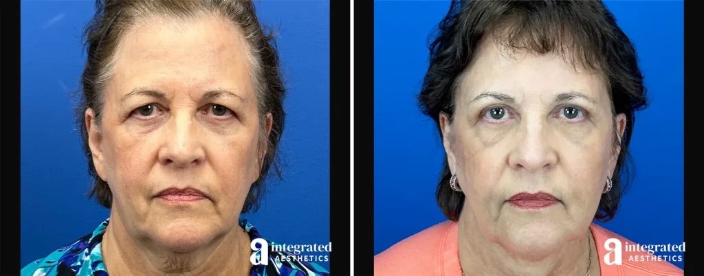 Endoscopic Brow Lift Before and After Patient Results
