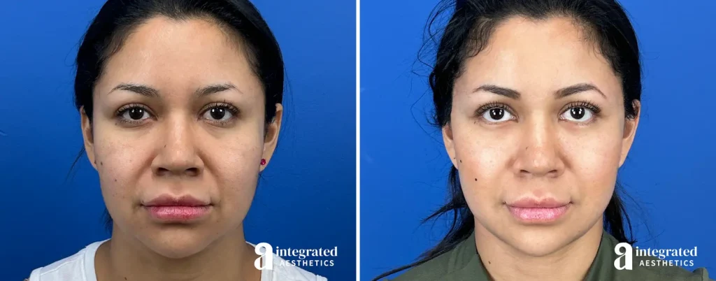 Endoscopic Brow Lift Before and After Patient Results