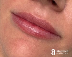 Lip Filler