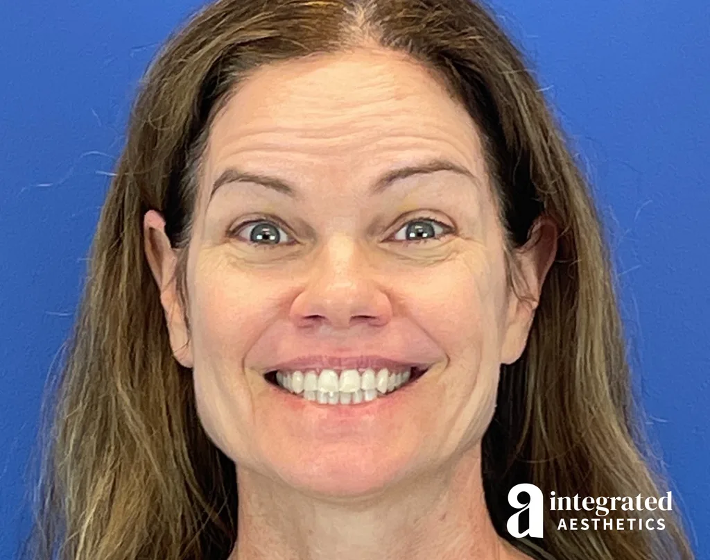 Wrinkle Relaxers