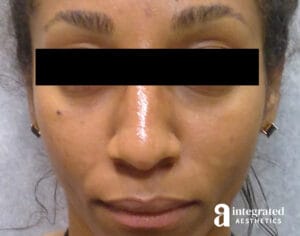 Dermal Fillers