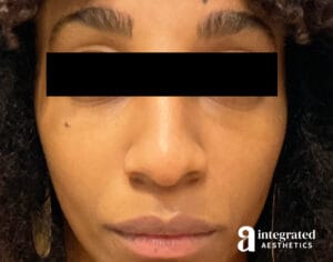 Dermal Fillers