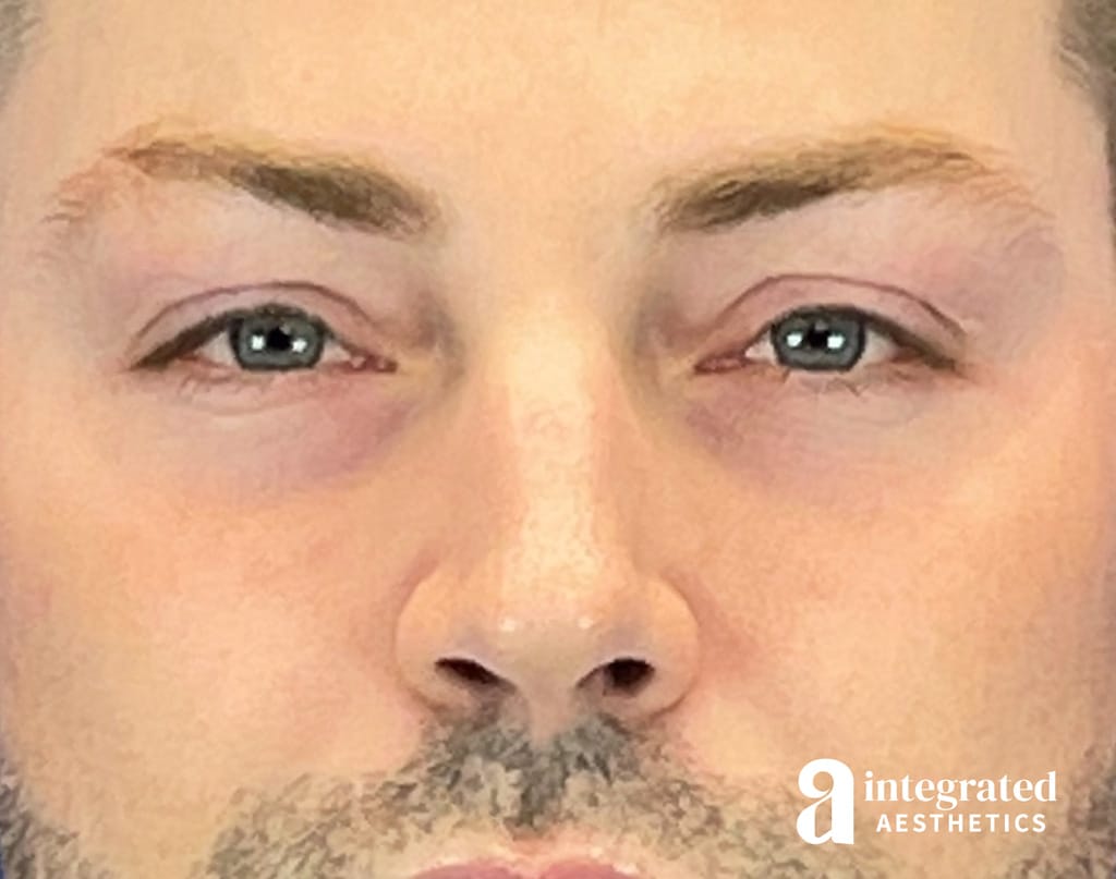 Non-surgical Blepharoplasty