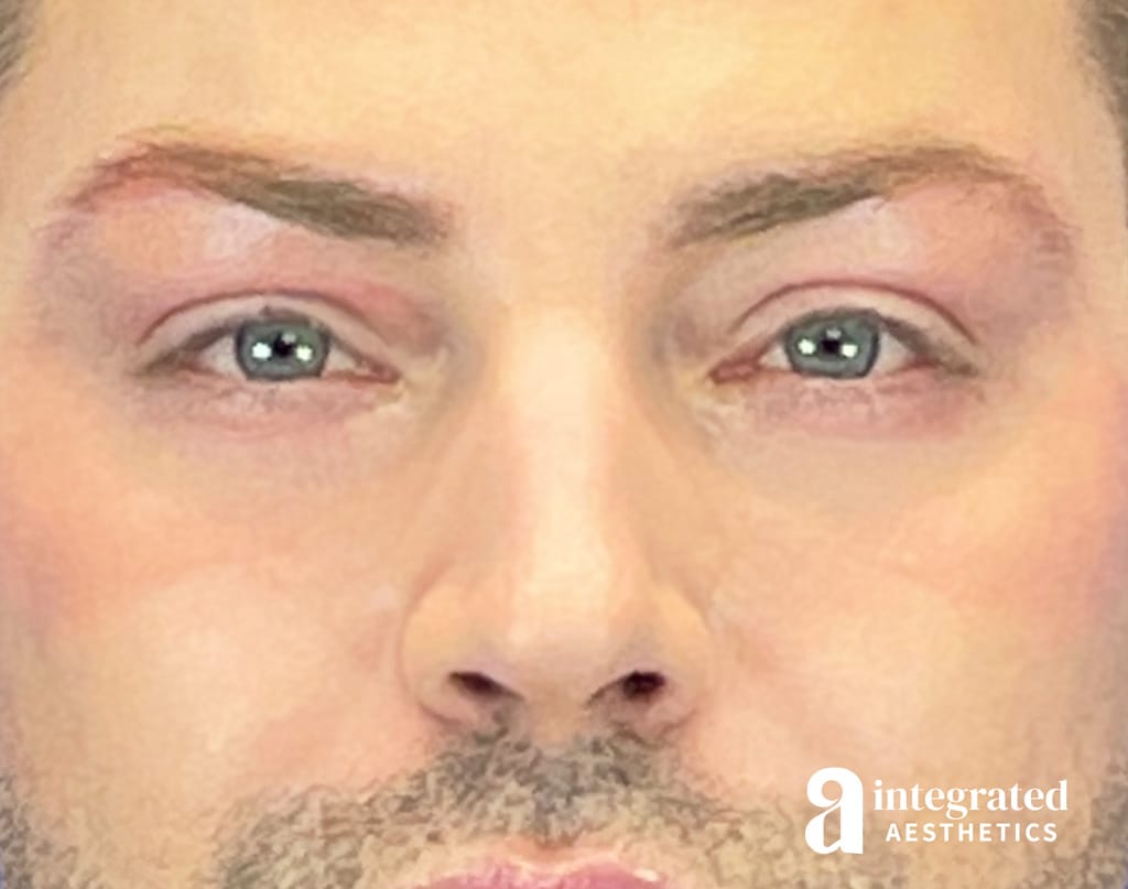 Non-surgical Blepharoplasty