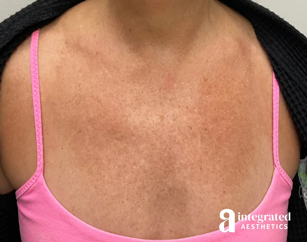 IPL Photofacial
