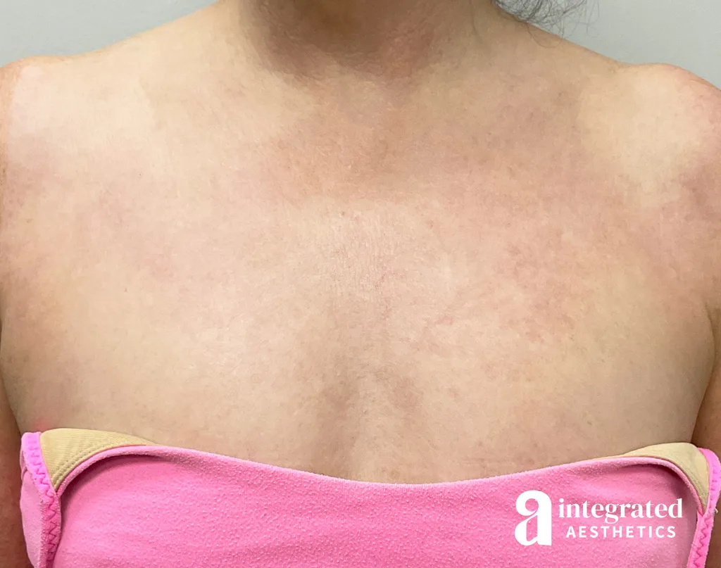 IPL Photofacial