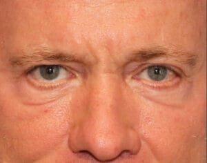Lower Blepharoplasty