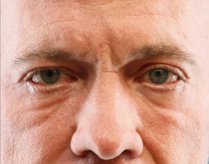 Lower Blepharoplasty