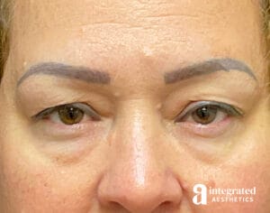 Blepharoplasty
