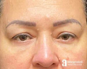 Blepharoplasty