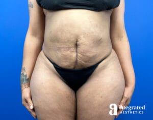 Tummy Tuck