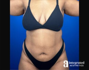 BodyTite with Liposuction