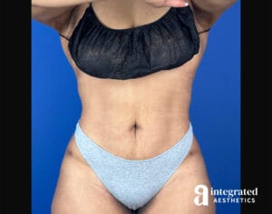 BodyTite with Liposuction