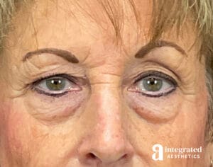 Blepharoplasty