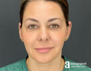 Facelift