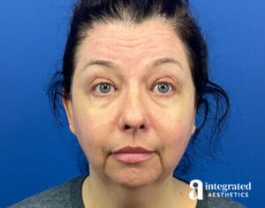 Wrinkle Relaxers