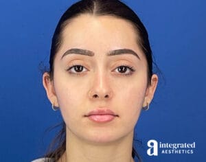 Dermal Filler and Wrinkle Relaxer