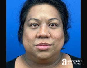 Facial Combined Procedures