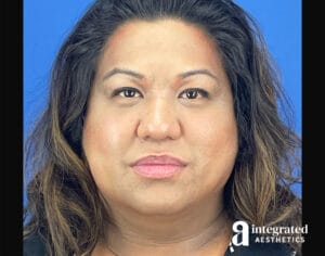 Facial Combined Procedures