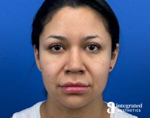 Facial Combined Procedures