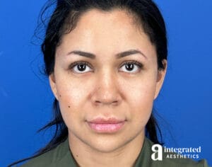 Facial Combined Procedures