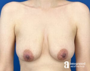 Breast Augmentation with Lift