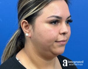 Submental Liposuction and Facetite