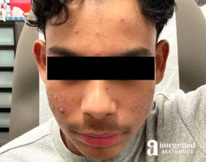 Accutane
