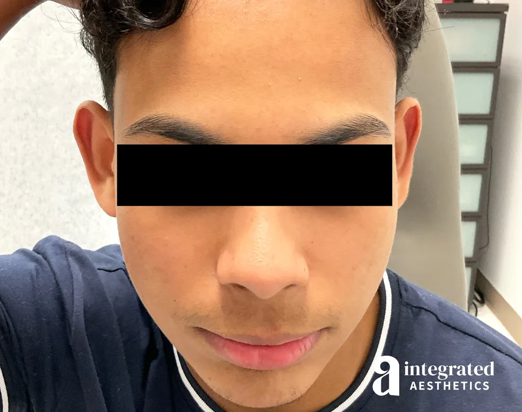 Accutane