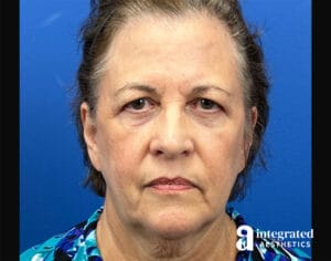 Quantum Facelift