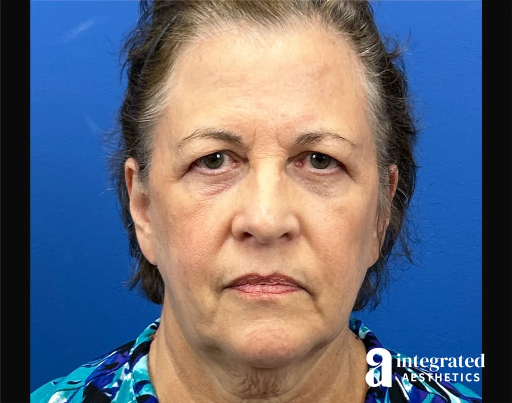 Quantum Facelift