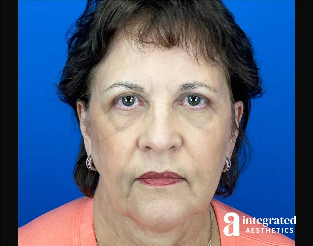 Quantum Facelift