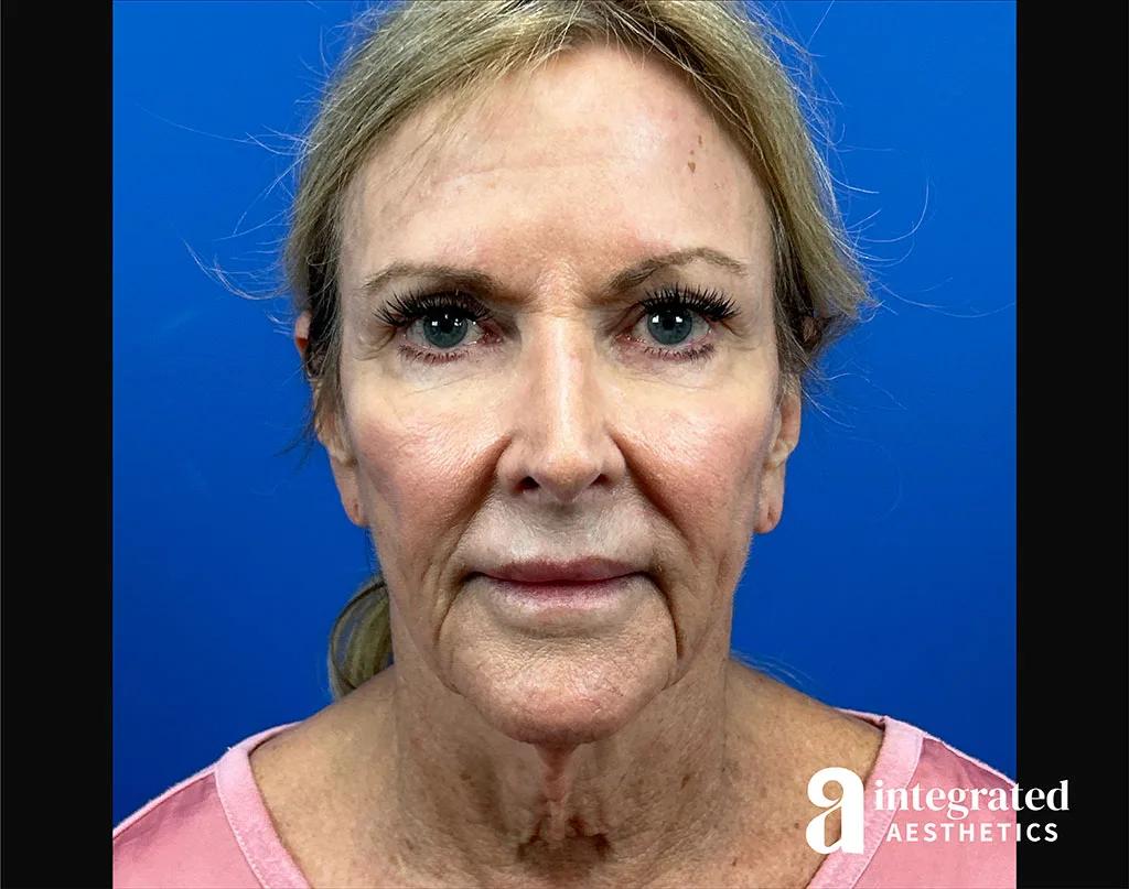 Facial Combined Procedures