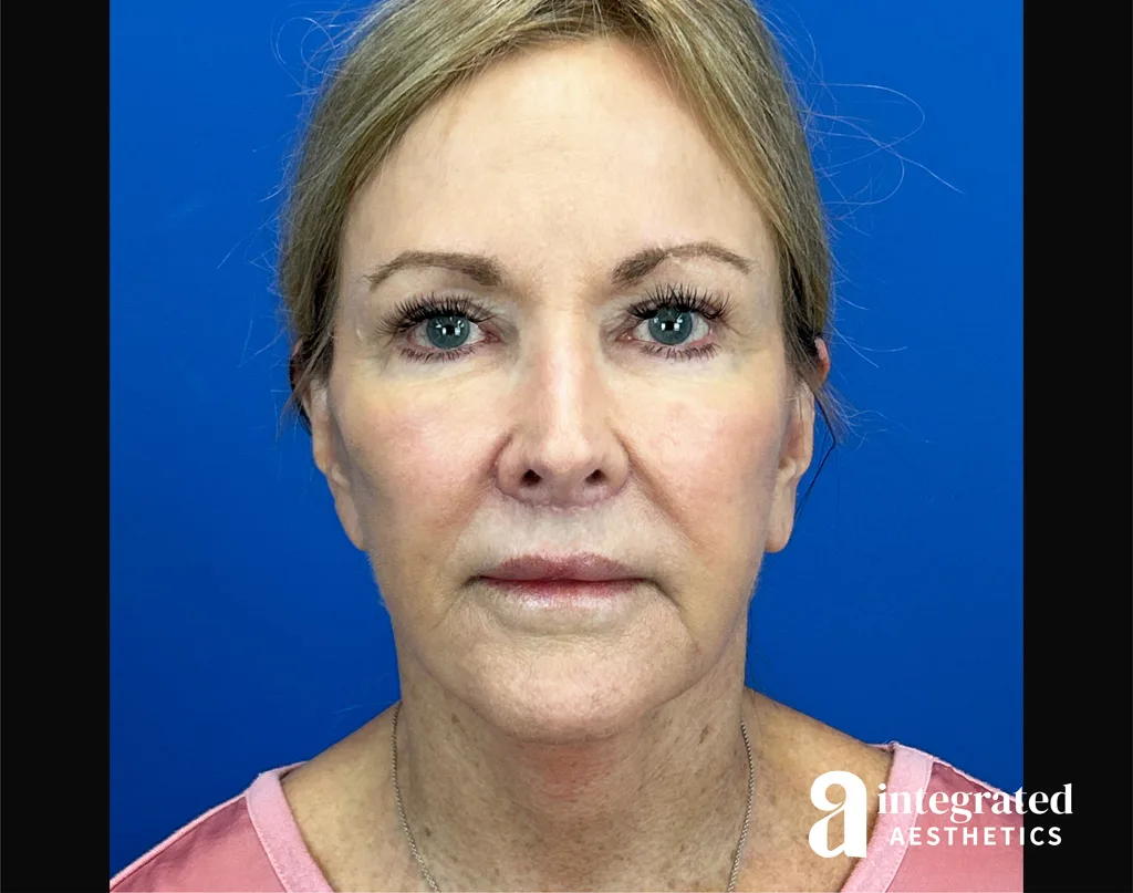 Facial Combined Procedures