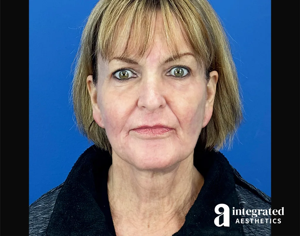 Facial Combined Procedures
