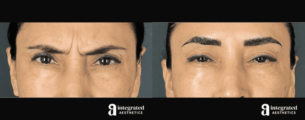Before and after Botox injections at Integrated Aesthetics