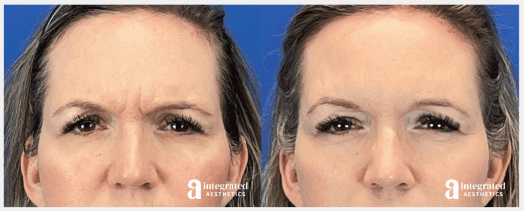 Female patient before and after Botox treatment for glabellar forehead lines at Integrated Aesthetics