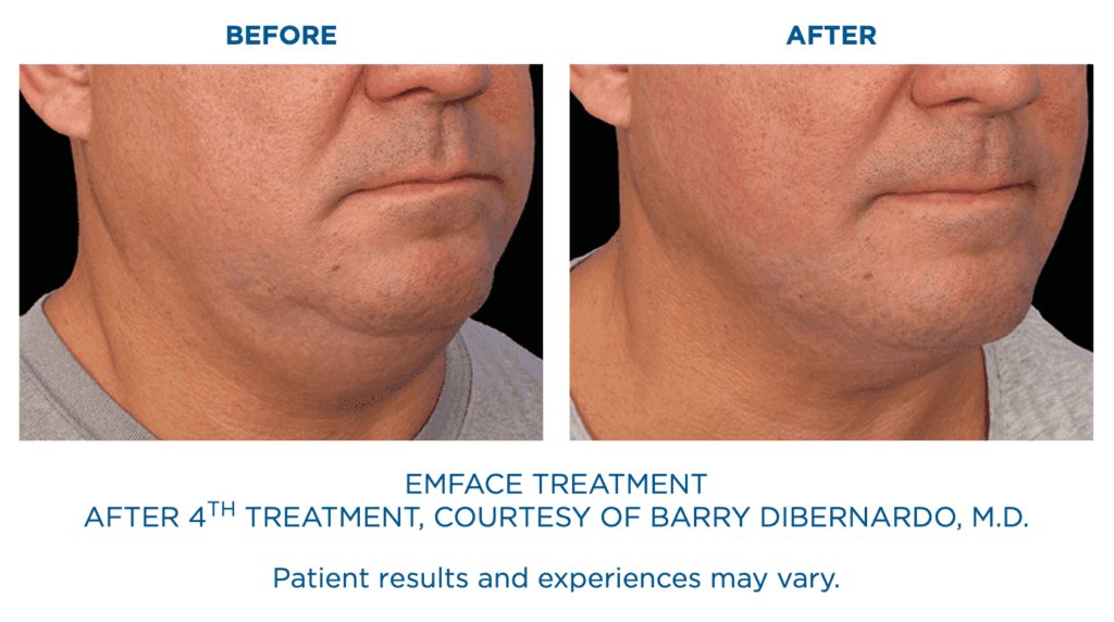 Emface Treatment Before and After: after 4th treatment, courtesy of Barry Dibernardo, MD