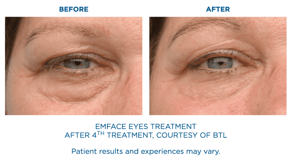 Emface Eyes Treatment Before and After: After 4th treatment, courtesy of BTL