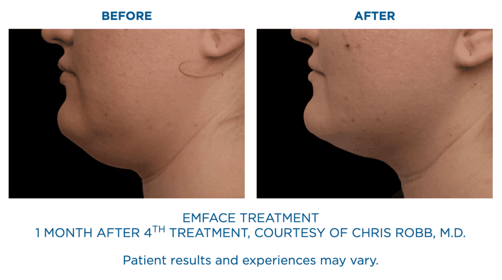 Emface Treatment Before and After: 1 month after 4th treatment, courtesy of Chris Robb, MD