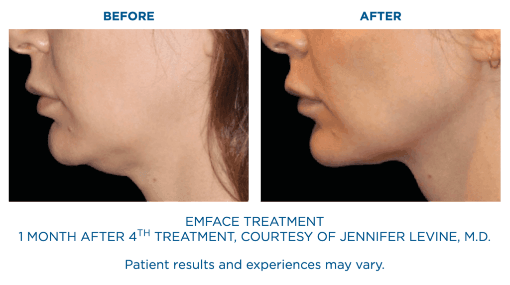Emface Treatment Before and After: 1 month after 4th treatment, courtesy of Jennifer Levine, MD