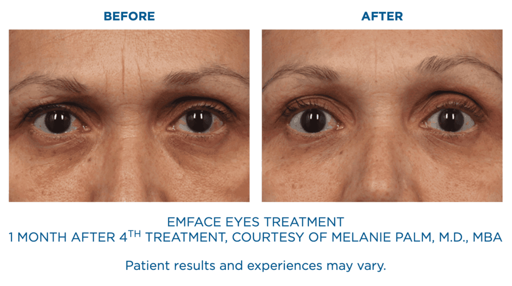 Emface Eyes Treatment Before and After: 1 month after 4th treatment, courtesy of Melanie Palm, MD, MBA