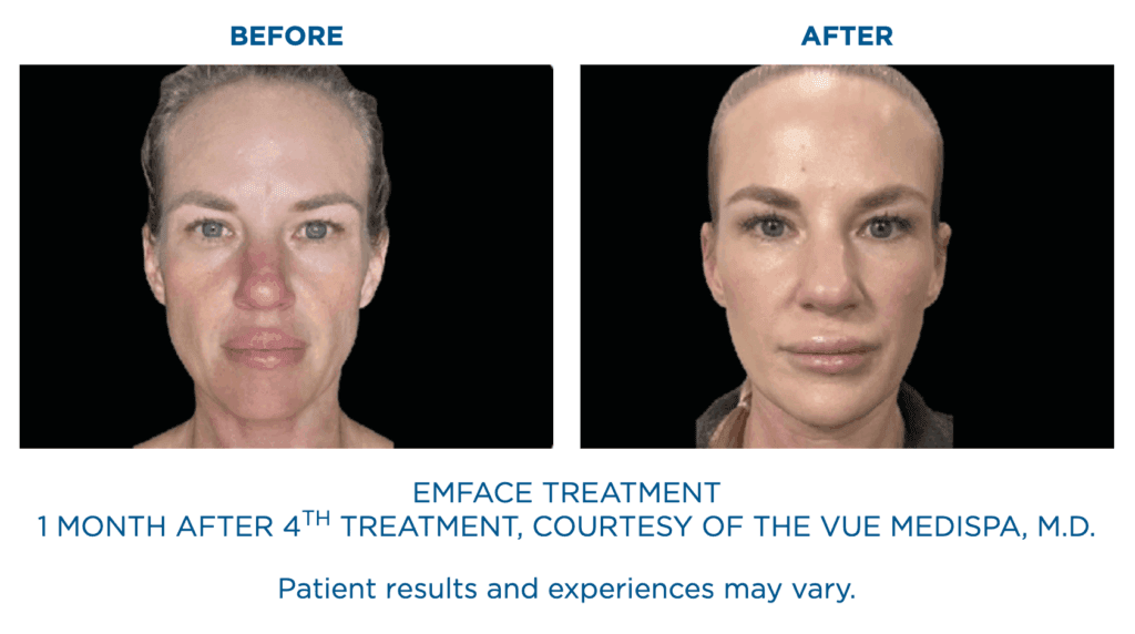 Emface Treatment Before and After: 1 month after 4th treatment, courtesy of the Vue Medispa, MD