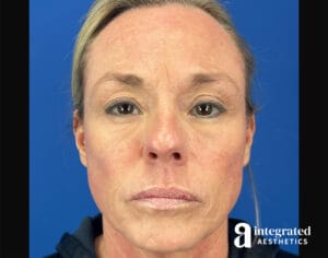 Facial Combined Procedures
