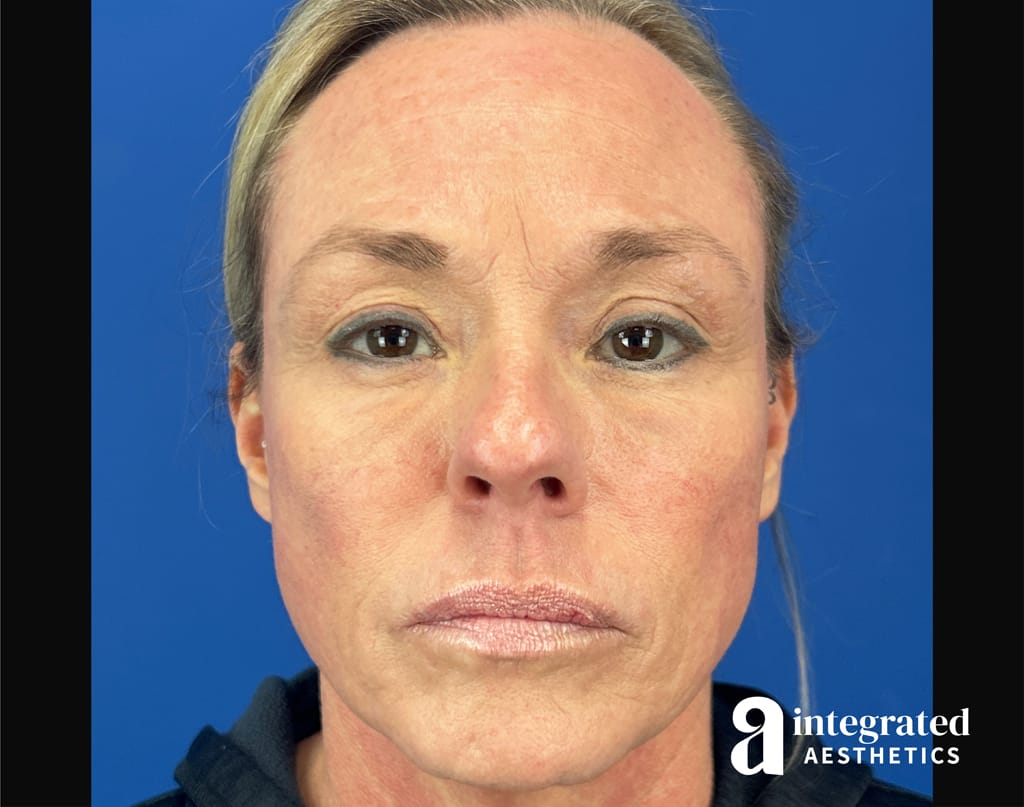 Facial Combined Procedures