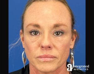 Facial Combined Procedures